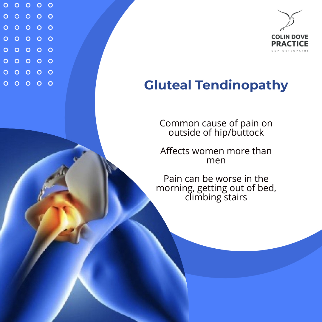 You are currently viewing Gluteal Tendinopathy